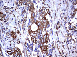 CD30 Antibody - IHC of paraffin-embedded Adenocarcinoma of Human breast tissue using anti-TNFRSF8 mouse monoclonal antibody.