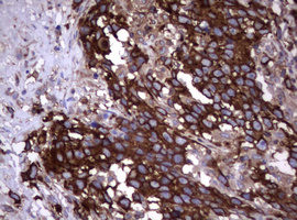 CD30 Antibody - IHC of paraffin-embedded Adenocarcinoma of Human ovary tissue using anti-TNFRSF8 mouse monoclonal antibody.
