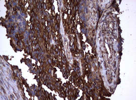 CD30 Antibody - IHC of paraffin-embedded Adenocarcinoma of Human endometrium tissue using anti-TNFRSF8 mouse monoclonal antibody.