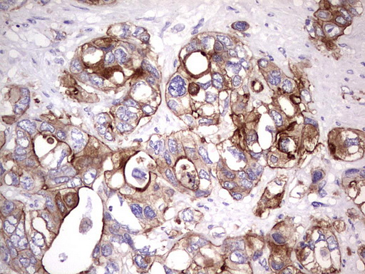 CD30 Antibody - IHC of paraffin-embedded Adenocarcinoma of Human colon tissue using anti-TNFRSF8 mouse monoclonal antibody. (heat-induced epitope retrieval by 1 mM EDTA in 10mM Tris, pH8.5, 120°C for 3min).