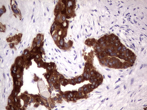 CD30 Antibody - IHC of paraffin-embedded Carcinoma of Human pancreas tissue using anti-TNFRSF8 mouse monoclonal antibody. (heat-induced epitope retrieval by 1 mM EDTA in 10mM Tris, pH8.5, 120°C for 3min).