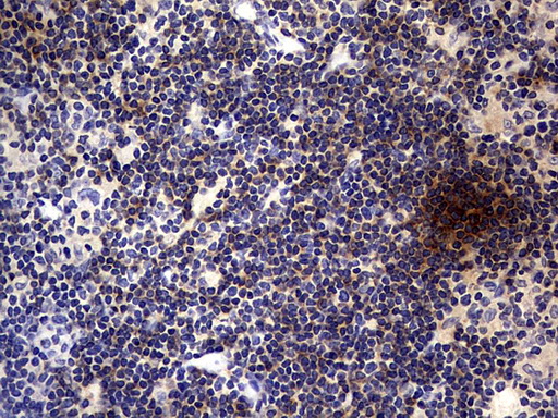 CD30 Antibody - IHC of paraffin-embedded Human lymphoma tissue using anti-TNFRSF8 mouse monoclonal antibody. (heat-induced epitope retrieval by 1 mM EDTA in 10mM Tris, pH8.5, 120°C for 3min).