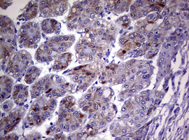 CD30 Antibody - IHC of paraffin-embedded Carcinoma of Human liver tissue using anti-TNFRSF8 mouse monoclonal antibody. (Heat-induced epitope retrieval by 10mM citric buffer, pH6.0, 120°C for 3min).
