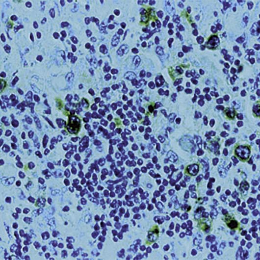 CD30 Antibody - Formalin-fixed, paraffin-embedded human Hodgkin lymphoma stained with CD30 antibody.