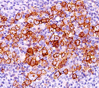 CD30 Antibody - CD30 antibody CD30/412 immunohistochemistry 20X-2.  This image was taken for the unmodified form of this product. Other forms have not been tested.