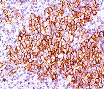 CD30 Antibody - CD30 antibody CD30/412 immunohistochemistry 20X-1.  This image was taken for the unmodified form of this product. Other forms have not been tested.