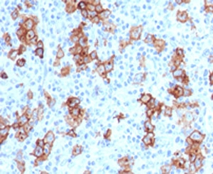 CD30 Antibody - IHC testing of FFPE human Hodgkin's lymphoma and CD30 antibody (CDLA30-1). This image was taken for the base form of this product. Alternate forms, such as conjugated, azide-free, or ready-to-use, have not been tested.