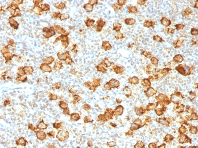 CD30 Antibody - Formalin-fixed, paraffin-embedded human Hodgkin's Lymphoma stained with CD30 Rabbit Recombinant Monoclonal Antibody (Ki-1/1505R).