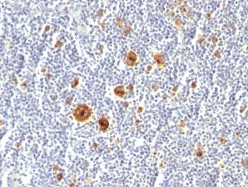 CD30 Antibody - Formalin-fixed, paraffin-embedded human Hodgkin's lymphoma stained with CD30 antibody (Ki-1/779).  This image was taken for the unmodified form of this product. Other forms have not been tested.