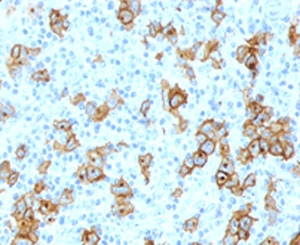 CD30 Antibody - Formalin-fixed, paraffin-embedded human Hodgkin's lymphoma stained with CD30 antibody (Ki-1/779). This image was taken for the base form of this product. Alternate forms, such as conjugated, azide-free, or ready-to-use, have not been tested.
