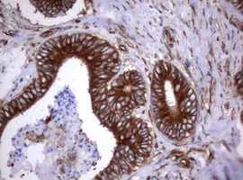 CD30 Antibody - IHC of paraffin-embedded Adenocarcinoma of Human colon tissue using anti-TNFRSF8 mouse monoclonal antibody.