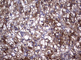 CD30 Antibody - IHC of paraffin-embedded Carcinoma of Human kidney tissue using anti-TNFRSF8 mouse monoclonal antibody.