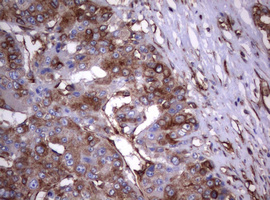 CD30 Antibody - IHC of paraffin-embedded Carcinoma of Human liver tissue using anti-TNFRSF8 mouse monoclonal antibody.