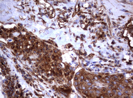 CD30 Antibody - IHC of paraffin-embedded Carcinoma of Human lung tissue using anti-TNFRSF8 mouse monoclonal antibody.