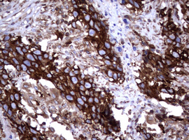 CD30 Antibody - IHC of paraffin-embedded Adenocarcinoma of Human ovary tissue using anti-TNFRSF8 mouse monoclonal antibody.