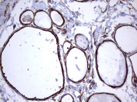 CD30 Antibody - IHC of paraffin-embedded Human thyroid tissue using anti-TNFRSF8 mouse monoclonal antibody.