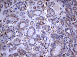 CD30 Antibody - IHC of paraffin-embedded Carcinoma of Human thyroid tissue using anti-TNFRSF8 mouse monoclonal antibody.