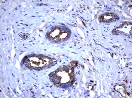 CD30 Antibody - IHC of paraffin-embedded Carcinoma of Human prostate tissue using anti-TNFRSF8 mouse monoclonal antibody.