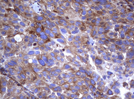 CD30 Antibody - IHC of paraffin-embedded Carcinoma of Human bladder tissue using anti-TNFRSF8 mouse monoclonal antibody.