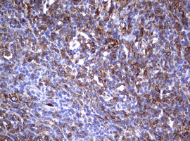CD30 Antibody - IHC of paraffin-embedded Human lymphoma tissue using anti-TNFRSF8 mouse monoclonal antibody.