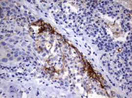CD30 Antibody - IHC of paraffin-embedded Carcinoma of Human lung tissue using anti-TNFRSF8 mouse monoclonal antibody.