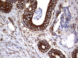 CD30 Antibody - IHC of paraffin-embedded Adenocarcinoma of Human colon tissue using anti-TNFRSF8 mouse monoclonal antibody.