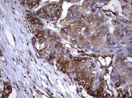 CD30 Antibody - IHC of paraffin-embedded Carcinoma of Human liver tissue using anti-TNFRSF8 mouse monoclonal antibody.