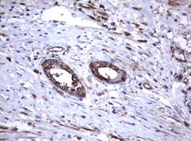 CD30 Antibody - IHC of paraffin-embedded Carcinoma of Human prostate tissue using anti-TNFRSF8 mouse monoclonal antibody.