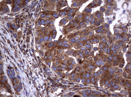 CD30 Antibody - IHC of paraffin-embedded Carcinoma of Human bladder tissue using anti-TNFRSF8 mouse monoclonal antibody.