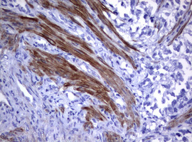 CD30 Antibody - IHC of paraffin-embedded Adenocarcinoma of Human endometrium tissue using anti-TNFRSF8 mouse monoclonal antibody.