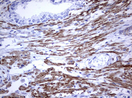 CD30 Antibody - IHC of paraffin-embedded Carcinoma of Human prostate tissue using anti-TNFRSF8 mouse monoclonal antibody.