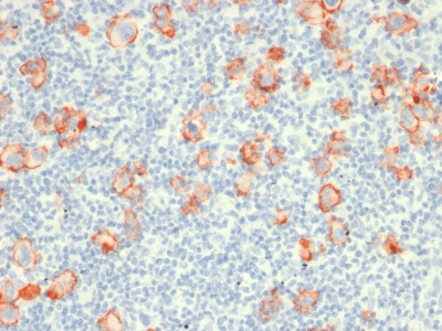 CD30 Antibody - Formalin-fixed, paraffin-embedded human Hodgkin's lymphoma stained with CD30 Mouse Recombinant Monoclonal Antibody (rCD30/412).