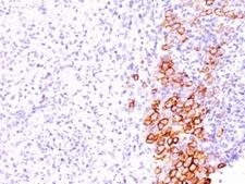 CD30 Antibody - Formalin-fixed, paraffin-embedded human Hodgkin's lymphoma stained with CD30 antibody (SPM609).  This image was taken for the unmodified form of this product. Other forms have not been tested.