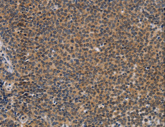CD30 Antibody - Immunohistochemistry of paraffin-embedded Human thyroid cancer using TNFRSF8 Polyclonal Antibody at dilution of 1:50.