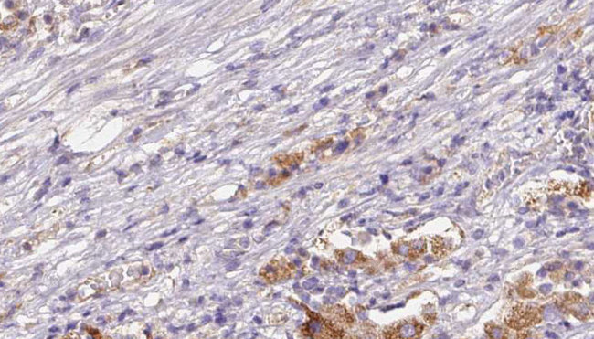 CD300LB Antibody - 1:100 staining human liver carcinoma tissues by IHC-P. The sample was formaldehyde fixed and a heat mediated antigen retrieval step in citrate buffer was performed. The sample was then blocked and incubated with the antibody for 1.5 hours at 22°C. An HRP conjugated goat anti-rabbit antibody was used as the secondary.