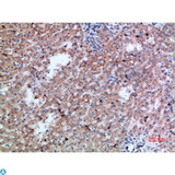 CD300LB Antibody - Immunohistochemical analysis of paraffin-embedded human-liver-cancer, antibody was diluted at 1:200.