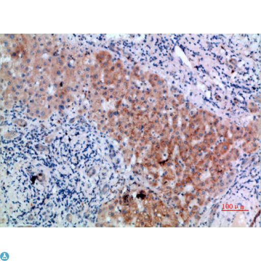 CD300LB Antibody - Immunohistochemical analysis of paraffin-embedded human-liver-cancer, antibody was diluted at 1:200.