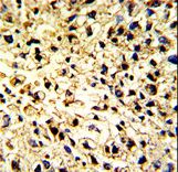 CD302 Antibody - Formalin-fixed and paraffin-embedded human hepatocarcinoma with DCL-1 Antibody , which was peroxidase-conjugated to the secondary antibody, followed by DAB staining. This data demonstrates the use of this antibody for immunohistochemistry; clinical relevance has not been evaluated.