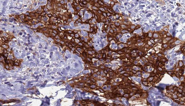 CD302 Antibody - 1:100 staining human Head and neck carcinoma tissue by IHC-P. The sample was formaldehyde fixed and a heat mediated antigen retrieval step in citrate buffer was performed. The sample was then blocked and incubated with the antibody for 1.5 hours at 22°C. An HRP conjugated goat anti-rabbit antibody was used as the secondary.