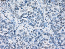 CD32A Antibody - IHC of paraffin-embedded Adenocarcinoma of ovary tissue using anti-FCGR2A mouse monoclonal antibody. (Dilution 1:50).
