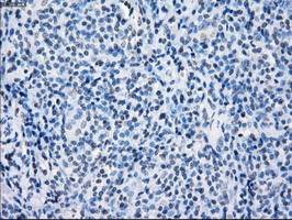 CD32A Antibody - IHC of paraffin-embedded Carcinoma of thyroid tissue using anti-FCGR2A mouse monoclonal antibody. (Dilution 1:50).