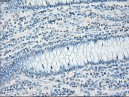 CD32A Antibody - IHC of paraffin-embedded Adenocarcinoma of colon tissue using anti-FCGR2A mouse monoclonal antibody. (Dilution 1:50).