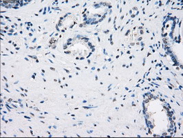 CD32A Antibody - IHC of paraffin-embedded Carcinoma of prostate tissue using anti-FCGR2A mouse monoclonal antibody. (Dilution 1:50).