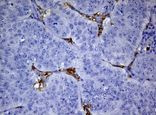 CD32A Antibody - Immunohistochemical staining of paraffin-embedded Adenocarcinoma of Human ovary tissue using anti-FCGR2A mouse monoclonal antibody.  heat-induced epitope retrieval by 10mM citric buffer, pH6.0, 120C for 3min)