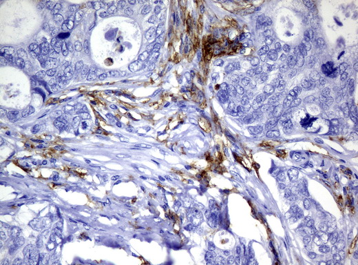 CD32A Antibody - Immunohistochemical staining of paraffin-embedded Adenocarcinoma of Human breast tissue using anti-FCGR2A mouse monoclonal antibody.  heat-induced epitope retrieval by 10mM citric buffer, pH6.0, 120C for 3min)