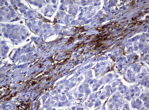 CD32A Antibody - Immunohistochemical staining of paraffin-embedded Carcinoma of Human liver tissue using anti-FCGR2A mouse monoclonal antibody.  heat-induced epitope retrieval by 10mM citric buffer, pH6.0, 120C for 3min)