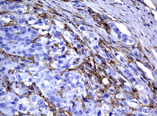 CD32A Antibody - Immunohistochemical staining of paraffin-embedded Adenocarcinoma of Human colon tissue using anti-FCGR2A mouse monoclonal antibody.  heat-induced epitope retrieval by 10mM citric buffer, pH6.0, 120C for 3min)