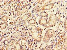 CD32A Antibody - Immunohistochemistry of paraffin-embedded human gastric cancer using FCGR2A Antibody at dilution of 1:100