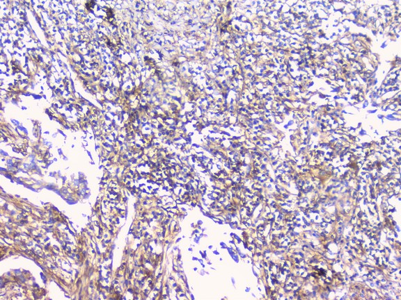 CD32A Antibody - IHC analysis of FCGR2A using anti-FCGR2A antibody. FCGR2A was detected in paraffin-embedded section of human lung cancer tissue. Heat mediated antigen retrieval was performed in citrate buffer (pH6, epitope retrieval solution) for 20 mins. The tissue section was blocked with 10% goat serum. The tissue section was then incubated with 1µg/ml rabbit anti-FCGR2A Antibody overnight at 4°C. Biotinylated goat anti-rabbit IgG was used as secondary antibody and incubated for 30 minutes at 37°C. The tissue section was developed using Strepavidin-Biotin-Complex (SABC) with DAB as the chromogen.