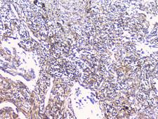 CD32A Antibody - IHC analysis of FCGR2A using anti-FCGR2A antibody. FCGR2A was detected in paraffin-embedded section of human lung cancer tissue. Heat mediated antigen retrieval was performed in citrate buffer (pH6, epitope retrieval solution) for 20 mins. The tissue section was blocked with 10% goat serum. The tissue section was then incubated with 1µg/ml rabbit anti-FCGR2A Antibody overnight at 4°C. Biotinylated goat anti-rabbit IgG was used as secondary antibody and incubated for 30 minutes at 37°C. The tissue section was developed using Strepavidin-Biotin-Complex (SABC) with DAB as the chromogen.